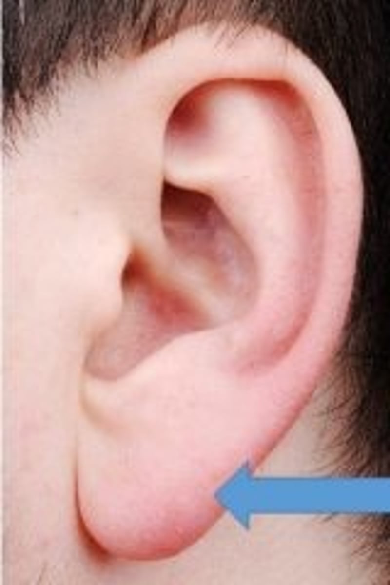 <p>Non-cartilaginous skin flap.</p>