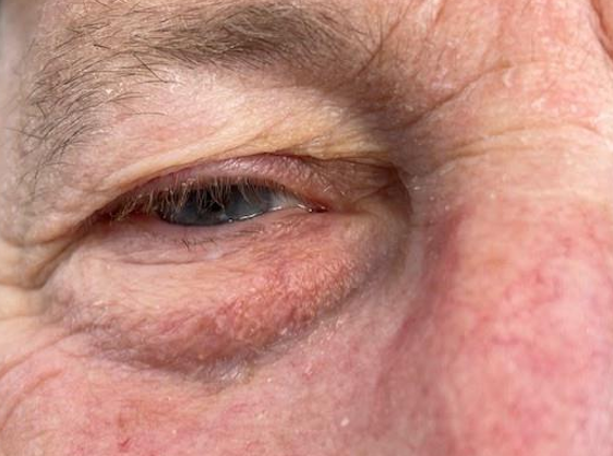 <p>Type of <strong>pseudoptosis</strong> that is an <strong>age-related </strong>“sagging” of upper and lower lids</p><ul><li><p>M&gt;F</p></li><li><p>Eyelash ptosis</p></li><li><p>Dry eye</p></li><li><p>Epiphora</p><ul><li><p>Lateral canthi are touching</p></li></ul></li><li><p>Superior VF defect</p></li></ul><p></p>