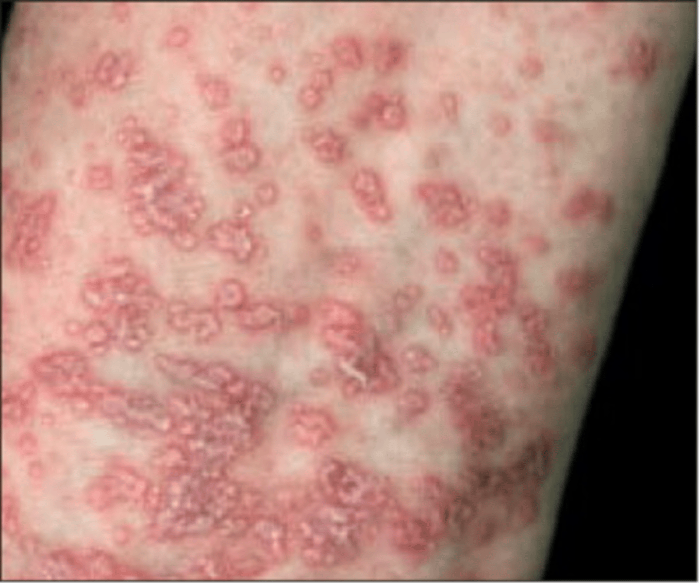 <p>_________________:</p><p>•Vacuoles appear in the lower epidermis</p><p>•Colloid bodies are also present</p><p>•Mature lesions are composed of CD8 cytotoxic T cells</p>