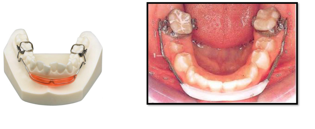 <p>Protrusion of upper anteriors and retrusion of lower anteriors</p><p>Lip trap</p><p>Muscular imbalance</p><p>Lower incisor collapse with lingual crowding</p><p>Mentolabial sulcus become accentuated</p><p>Treat- Lip bumper</p>