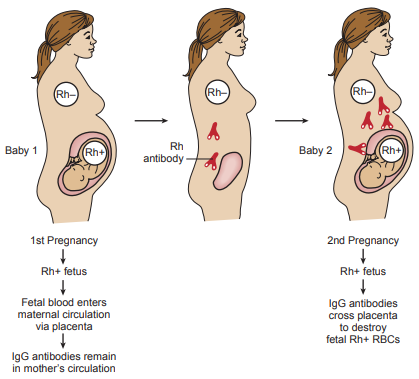 Figure 2: Rh bodies destroy Rh+ RBCs