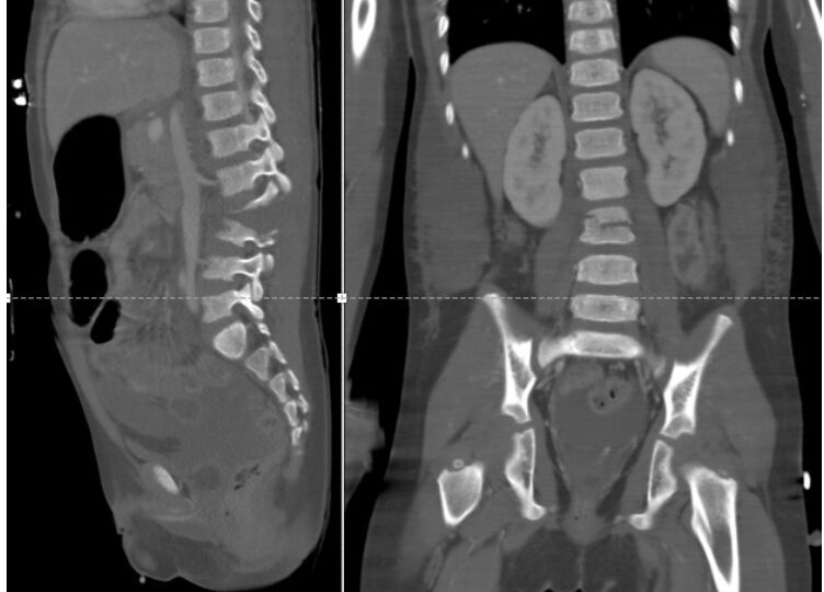 <p>CIR - fratura de chance: local</p>