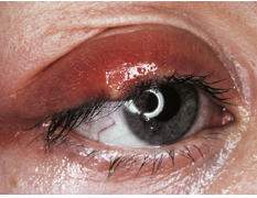 <p>Describe these ABNORMAL findings (Assume OD)</p>