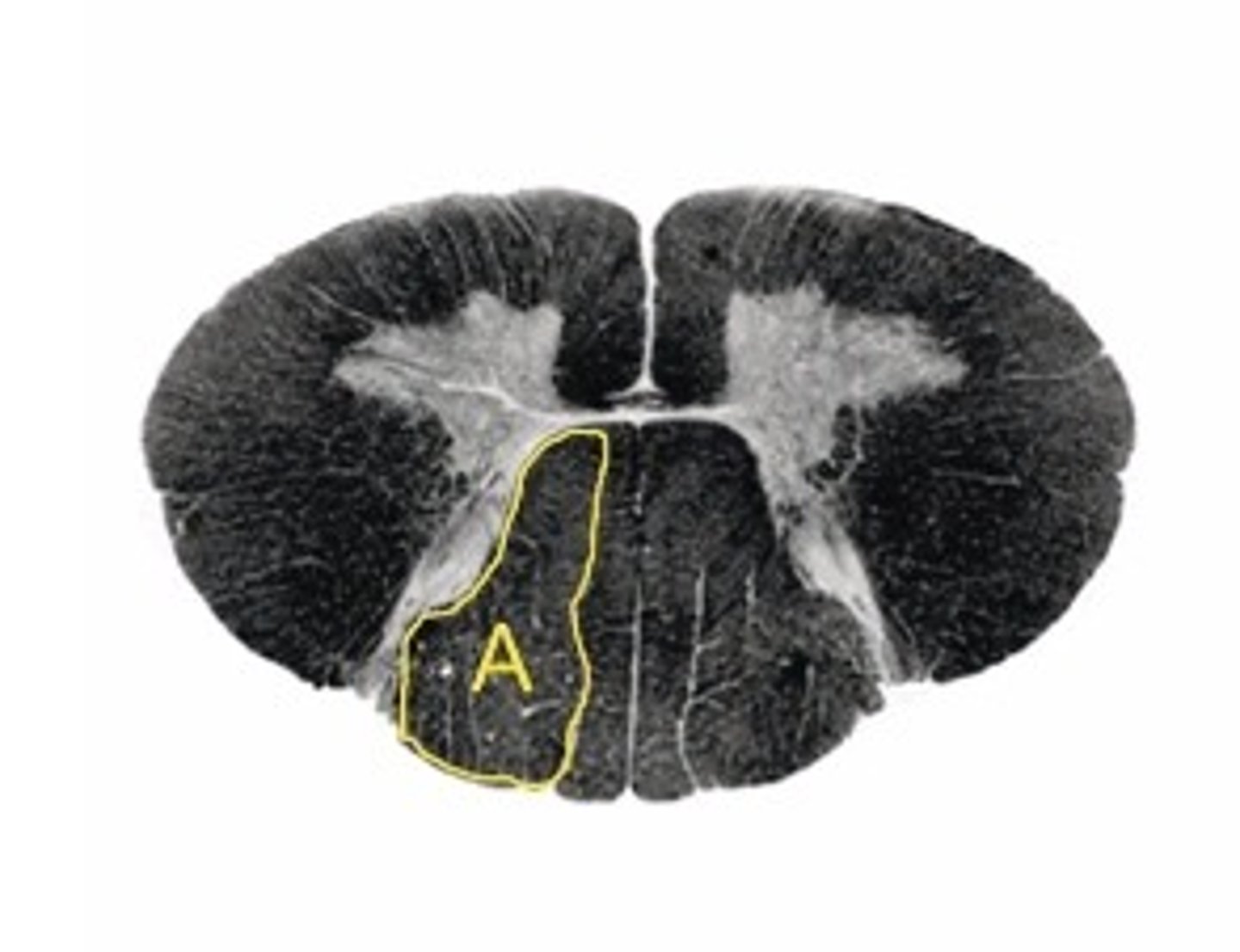<p>Describe the signs/symptoms that you will see if structure "A" is lesioned.</p>