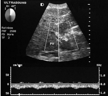 <p><span>A patient presents with a history of hepatitis C and abdominal distention. The finding in this duplex image of the porta hepatis is most com- monly associated with which of the following conditions?</span></p>