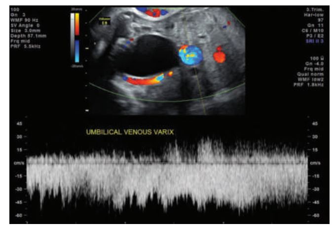 <p> _________ the umbilical vessels affecting the umbilical artery and vein, respectively. Focal dilation of the umbilical vein is nearly always intraabdominal, but extrahepatic in location. </p><p>A varix appears on sonography as a dilated intraabdominal, extrahepatic portion of the umbilical vein. Color Doppler shows continuity with the umbilical vein.</p>
