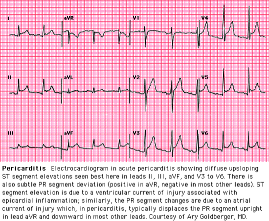 <p>What does this ECG indicate?</p>