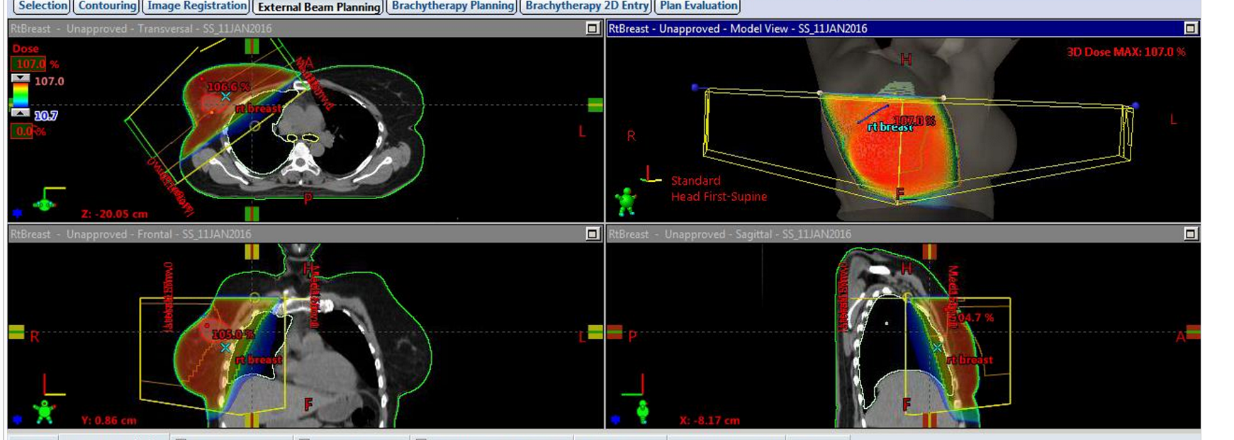 <p>what is one thing that may be an issue with this patient’s two field tangential treatment</p>