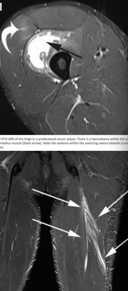 <p>Thigh Strain</p>