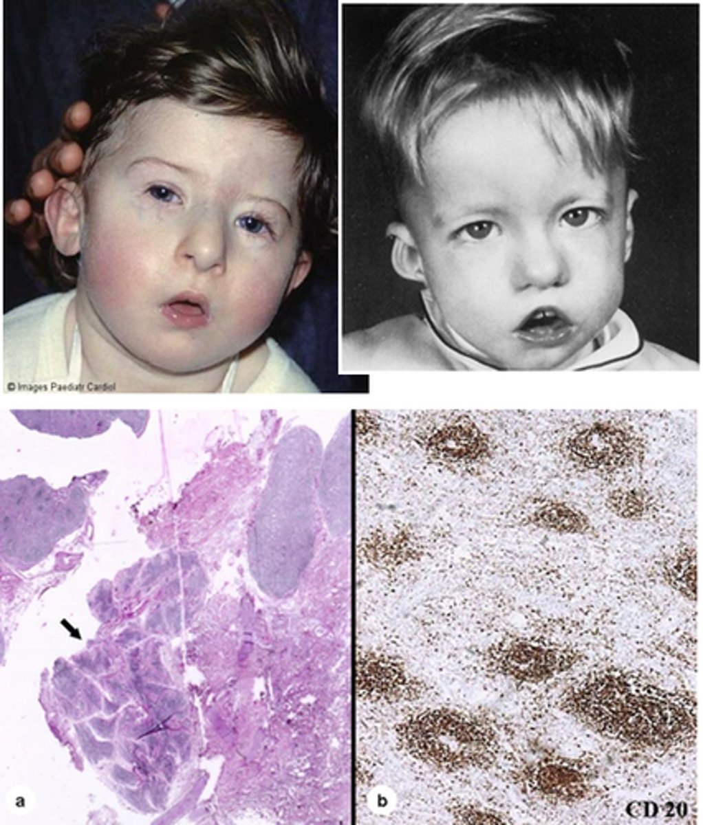 <p>Involves abnormalities of the heart, parathyroid gland, face, and thymus gland.</p><p>Affected individuals will have congenital heart disease, unusual facial features with low-set ears, a small receding mandible, wide-set eyes and are born without parathyroid glands</p>