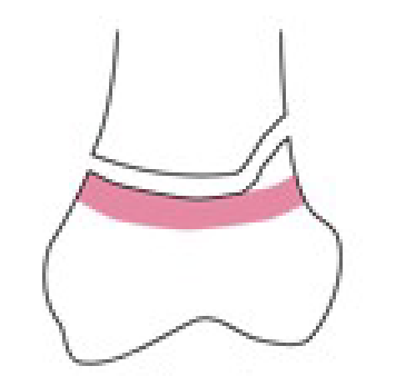 <p>Name this fracture</p>