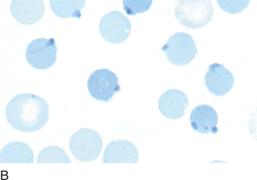 <p>what are heinz bodies? (RBC inclusions)</p>