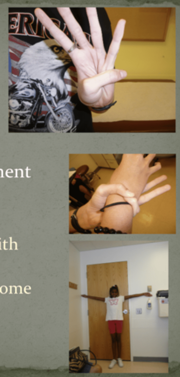 <p>Marfan syndrome</p><p>(as states, risk of aortic root dissection + retinal detachment so docs will refer often to genetics to see</p><p>thumb sign, thumb sticks out, pinky and thumb wrap around wrist, will overlap)</p>