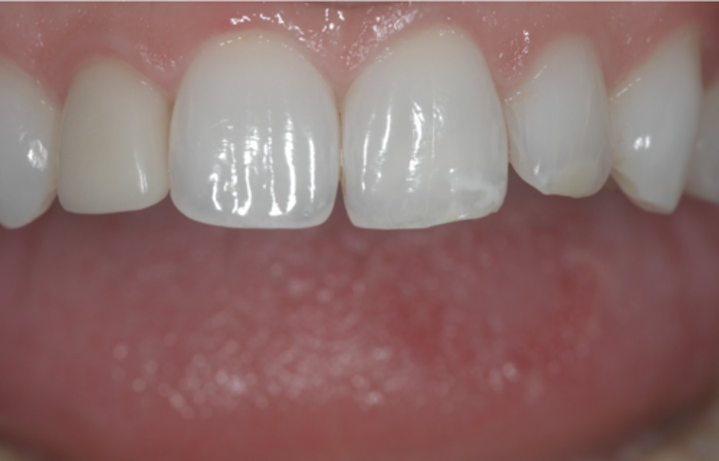 <p>Compare Crown #7 during a try-in visit and Natural Tooth #10. Which one is correct?</p><p>Hint: The lighter the color, the higher the value. No color has higher value than white and no color has lower value than black.</p><p>A) You should consider stain Crown #7 to increase its value.</p><p>B) You realize that you are unable to increase value of Crown #7. You decide to return this crown to the lab and request to change not only the shade but also translucency and surface characters.</p>
