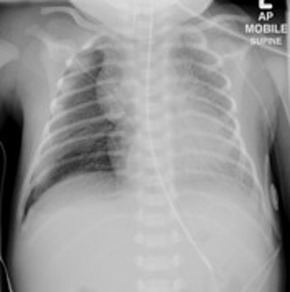 <p>Hyaline membrane diseasee or respiratory distress syndrome (RDS)</p>