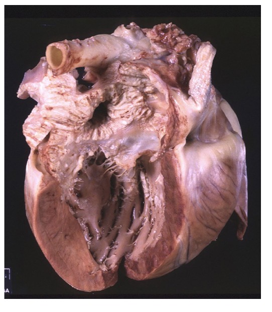 <p>chronic dilated hearts, healed ulcerative endocarditis (uraemia), jet lesions (valvular stenosis/regurgitation)</p>