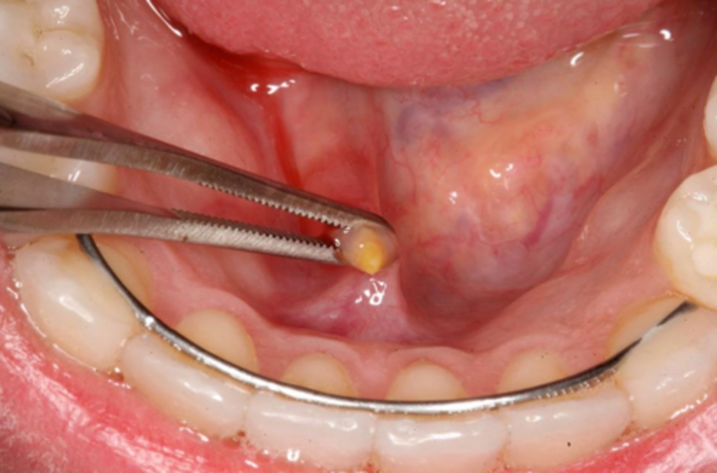 <p>sialolithiasis</p>