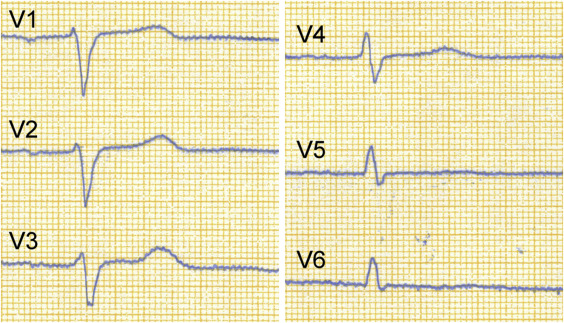 <p>Necrosis indicators like<strong> disappearance of R-wave,</strong> formation of <strong>pathological Q-waves, and T-wave inversions.</strong></p><p>The disappearance of R-wave in an electrocardiogram indicates myocardial infarction or necrosis of heart tissue.</p><p>photo: poor R wave </p>