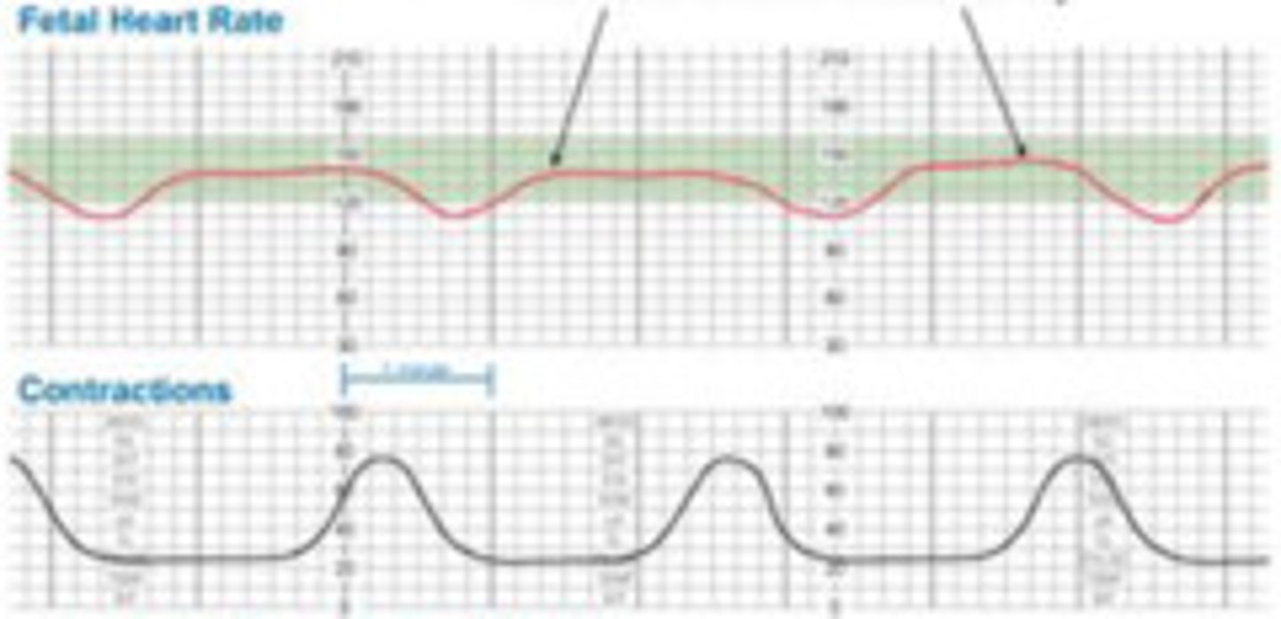 <p>late decel (begin at peak of contraction and slowly return back to baseline after contraction has finished) they may degrade into bradycardias as labor progresses</p>
