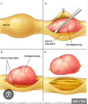 <p>Which STS originates from <strong>connective tissue of nerve sheaths?</strong></p>