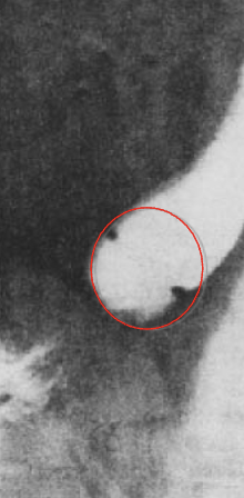 <p>What esophageal disorder is this?</p>