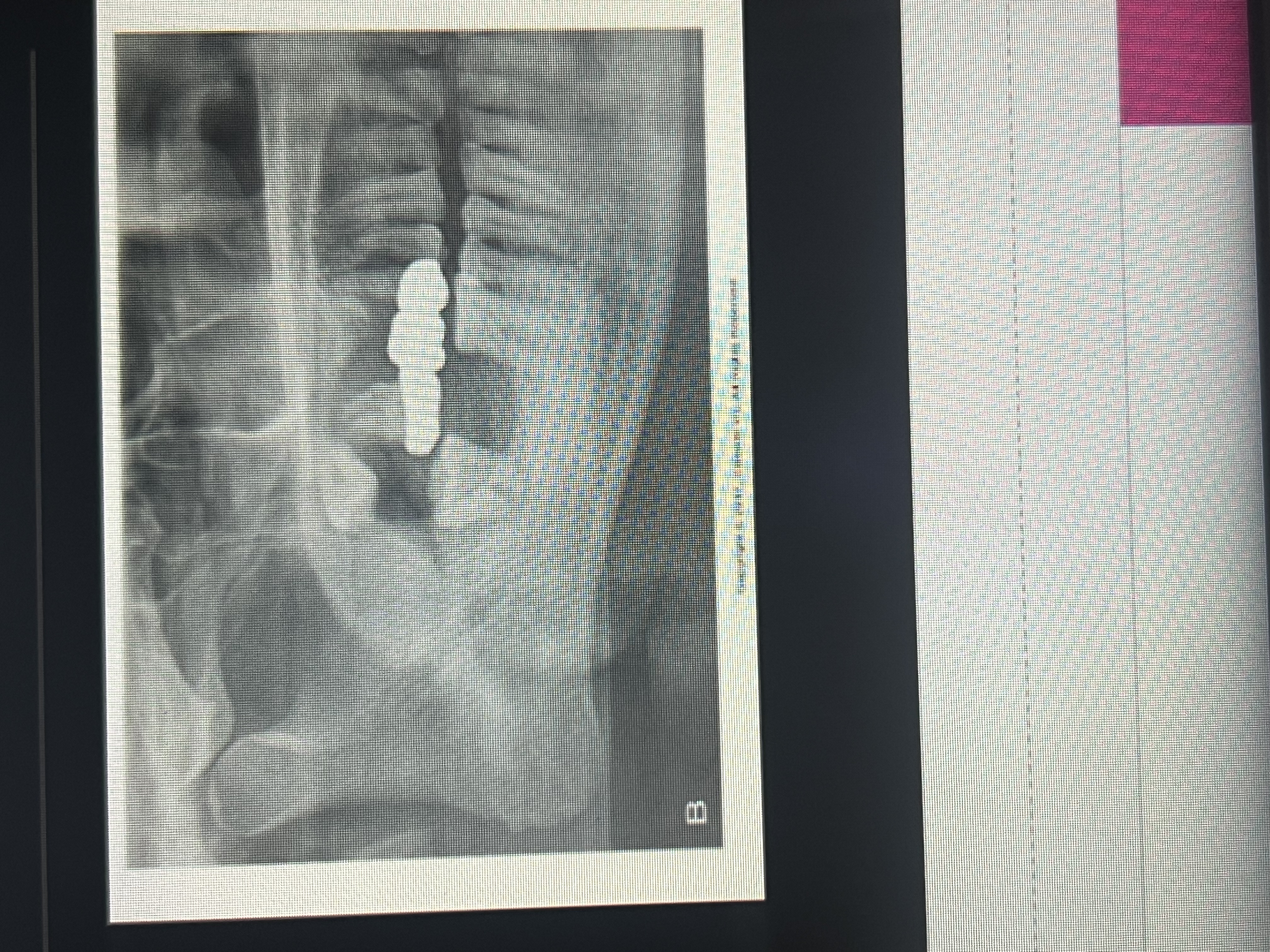 <p>Loss of bone in the maxillar or mandible that surrounds &amp; supports teeth.</p>