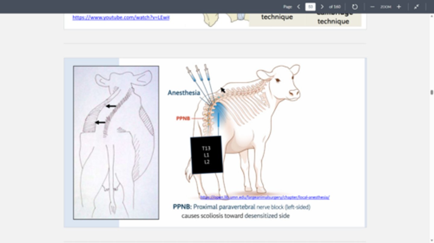 <p>scoliosis toward desensitized side</p>