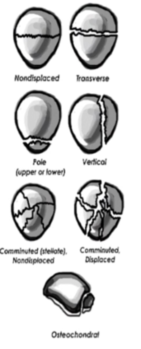 <p>- transverse (displaced or nondisplaced, use lateral x-ray to see)<br>- vertical (displaced or non displaced)<br>- comminuted (displaced or nondisplaced)<br>- avulsion</p>