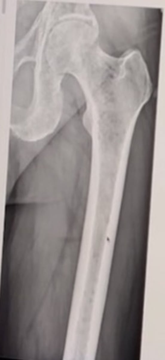 <p>54 year old male with severe fatigue.</p><p>The most likely SKULL radiographic name sign seen with this condition is:</p><p>Asterion defect</p><p>Cotton wool skull</p><p>Pepper pot sign</p><p>Raindrop skull</p>