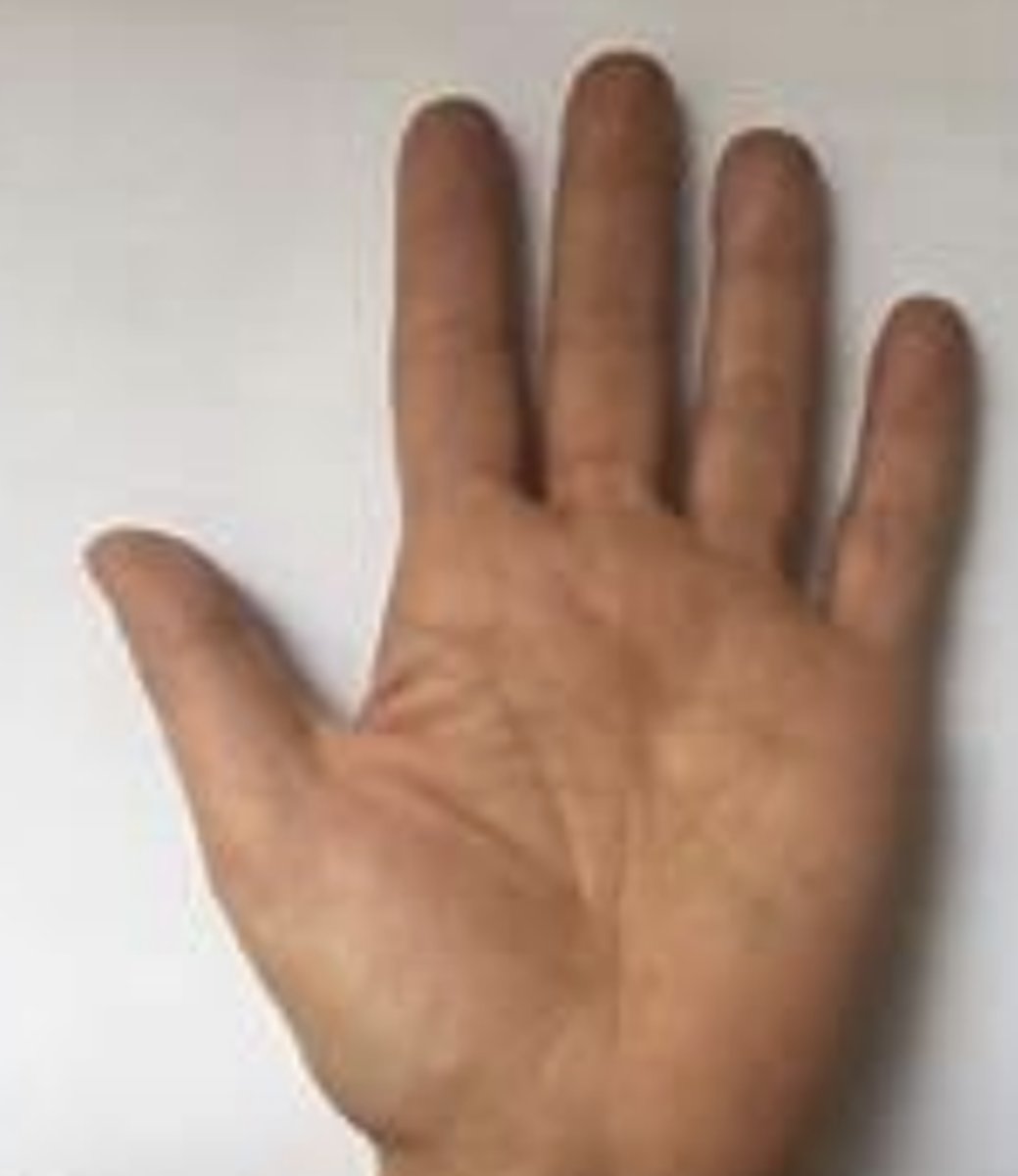 <p>palm of the hand</p><p>hand is supinated</p>