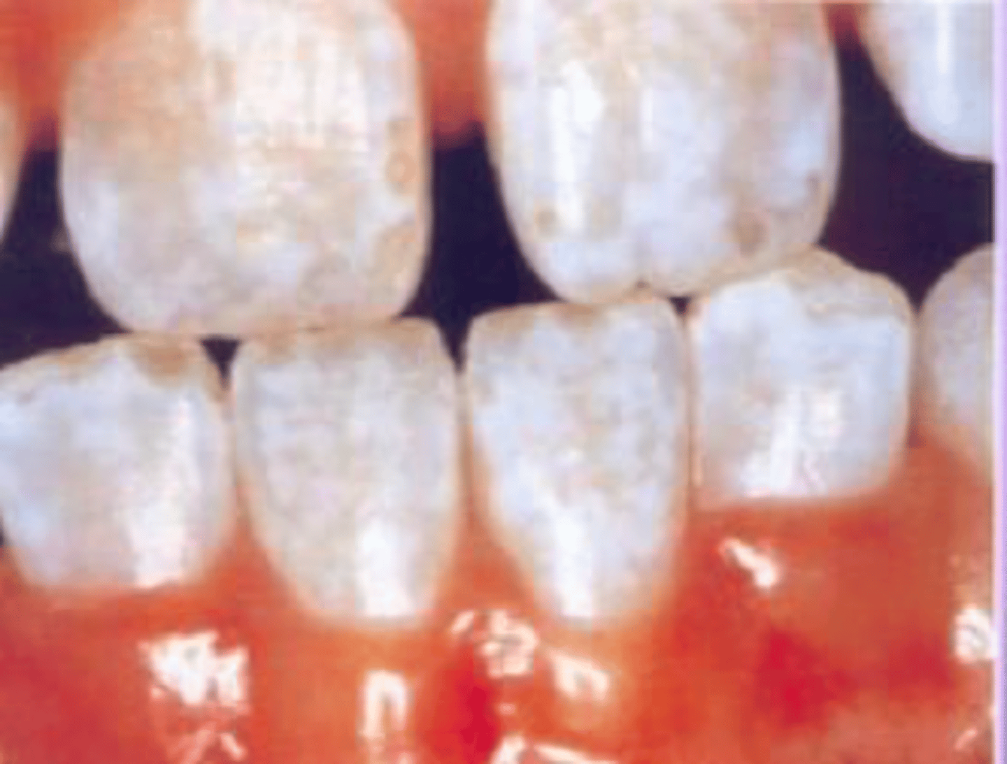 <p>White spots on the teeth, insufficient growth of the enamel crystals deposited in the matrix</p>