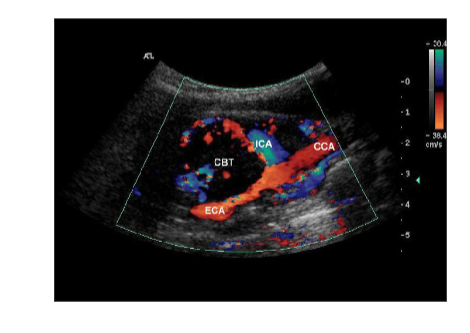 <p>What causes a carotid body tumor (CBT) what is it?</p>