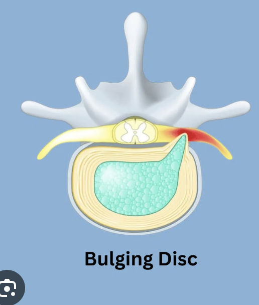 <p>Nucleus pulposus flattens and bulges outward, possibly entering the vertebral canal<span><span>, with its outer layer remaining intact, often due to aging or wear and tear</span></span></p>