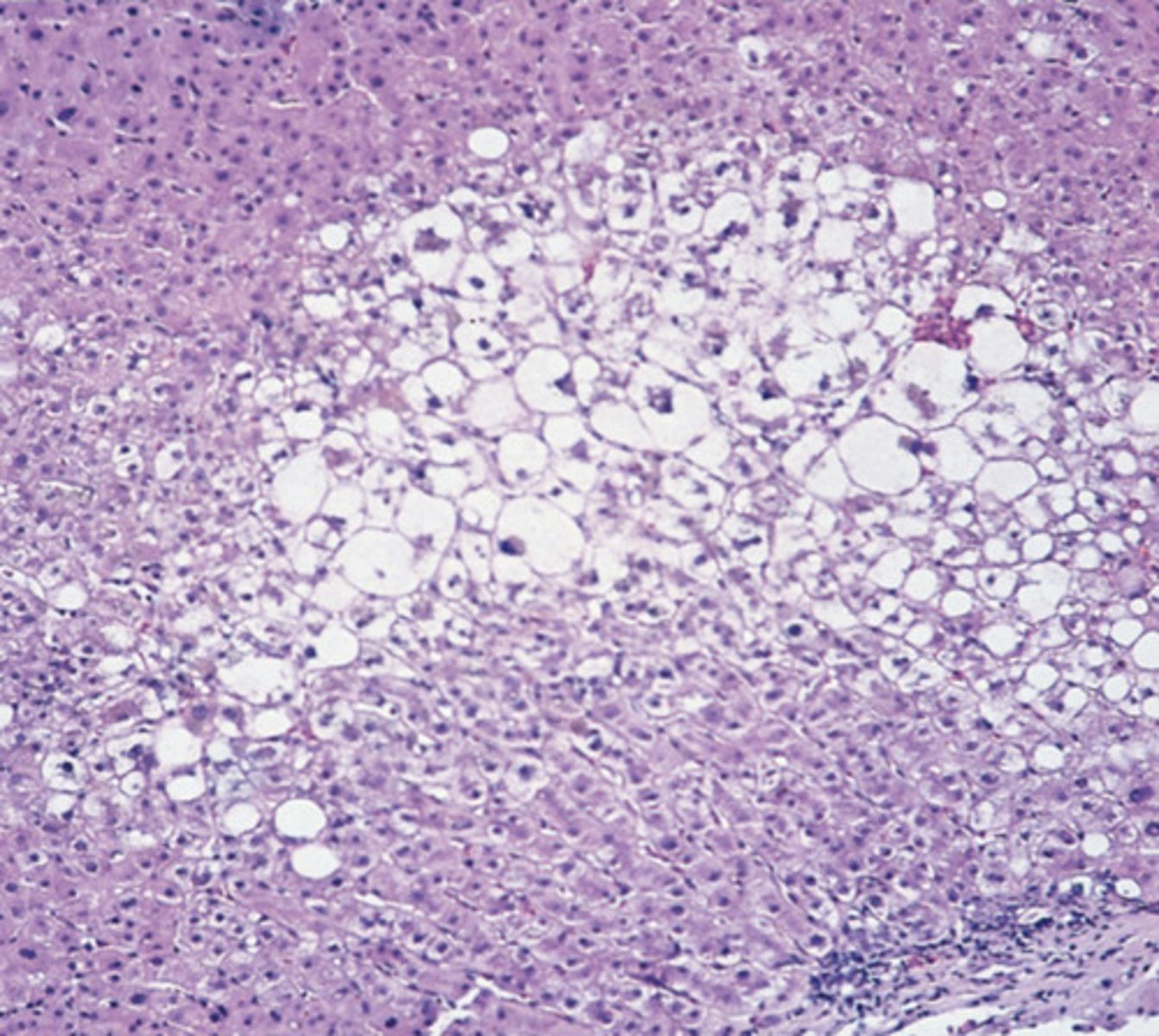 <p>What cellular accumulation is occurring in this image?</p>