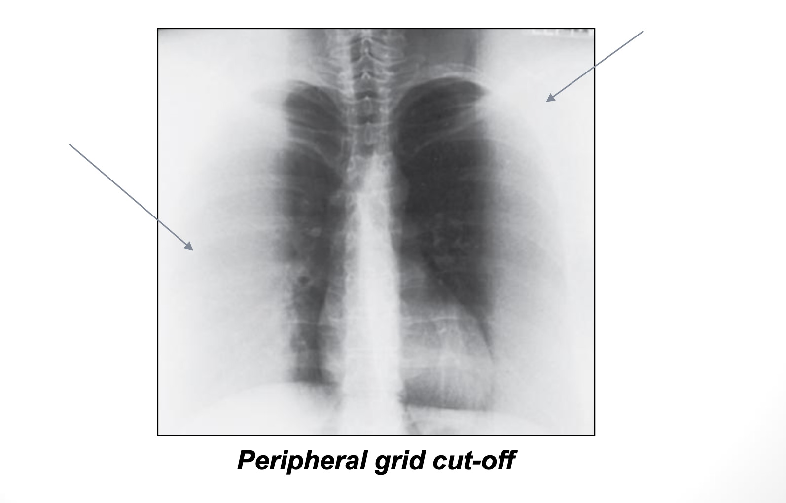 <p><strong>What is a Peripheral Grid Cut-off? </strong>(For comp)</p>