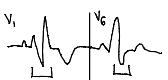 <p>disruption of impulse from bundle of His through right bundle branch</p><ul><li><p>QRS > 0.12 sec (V<sub>1</sub>)</p></li><li><p>V<sub>1</sub> = rsR’ pattern (“M,” “bunny ears”)</p></li><li><p>V<sub>6</sub> = negative S wave</p></li></ul><p></p>