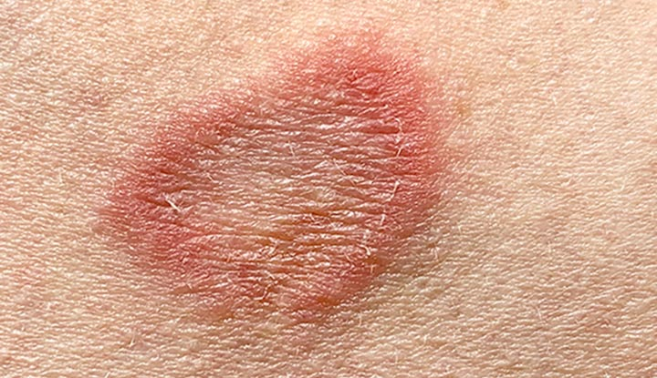 <ol><li><p>body = boarder is circular, raised, red rash, with scaly or dry center </p></li><li><p>scalp = scaly patches, hair breakage, temp baldness</p></li><li><p>groin = red, itchy rash </p></li><li><p>foot = scaly, cracked </p></li><li><p>nail = thicken, discolored, brittle nail</p></li></ol><p></p>