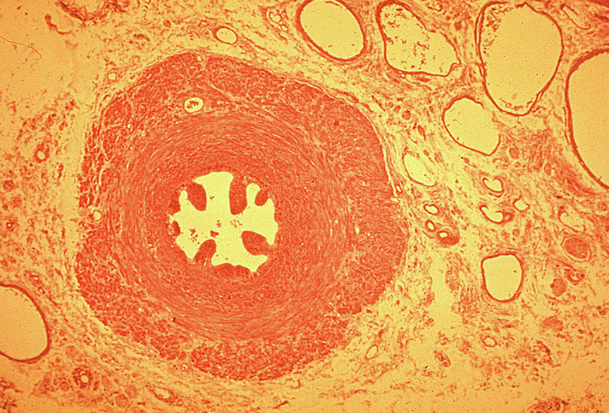 <p><strong>Vas deferens</strong></p><ul><li><p class=""><strong>Pseudostratified columnar epithelium</strong> with <strong>stereocilia</strong></p></li><li><p class=""><strong>Small, irregular star-shaped lumen</strong> compared to thick wall</p></li><li><p class="">Surrounded by a <strong>very thick muscularis</strong> with <strong>three layers</strong>: inner longitudinal, middle circular, outer longitudinal</p></li><li><p class="">Often has a <strong>folded mucosa</strong></p></li></ul><p></p><p><em>Vas deferens stores sperm</em></p>