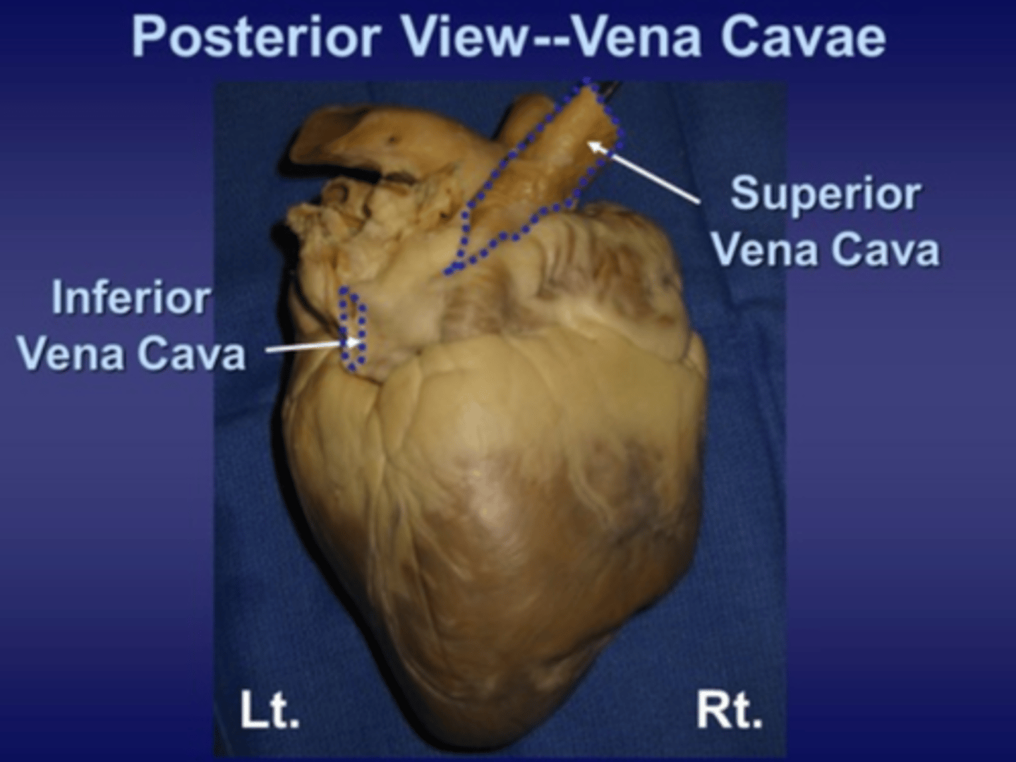 <p>blood vessel that returns blood from above the heart back to the heart</p>