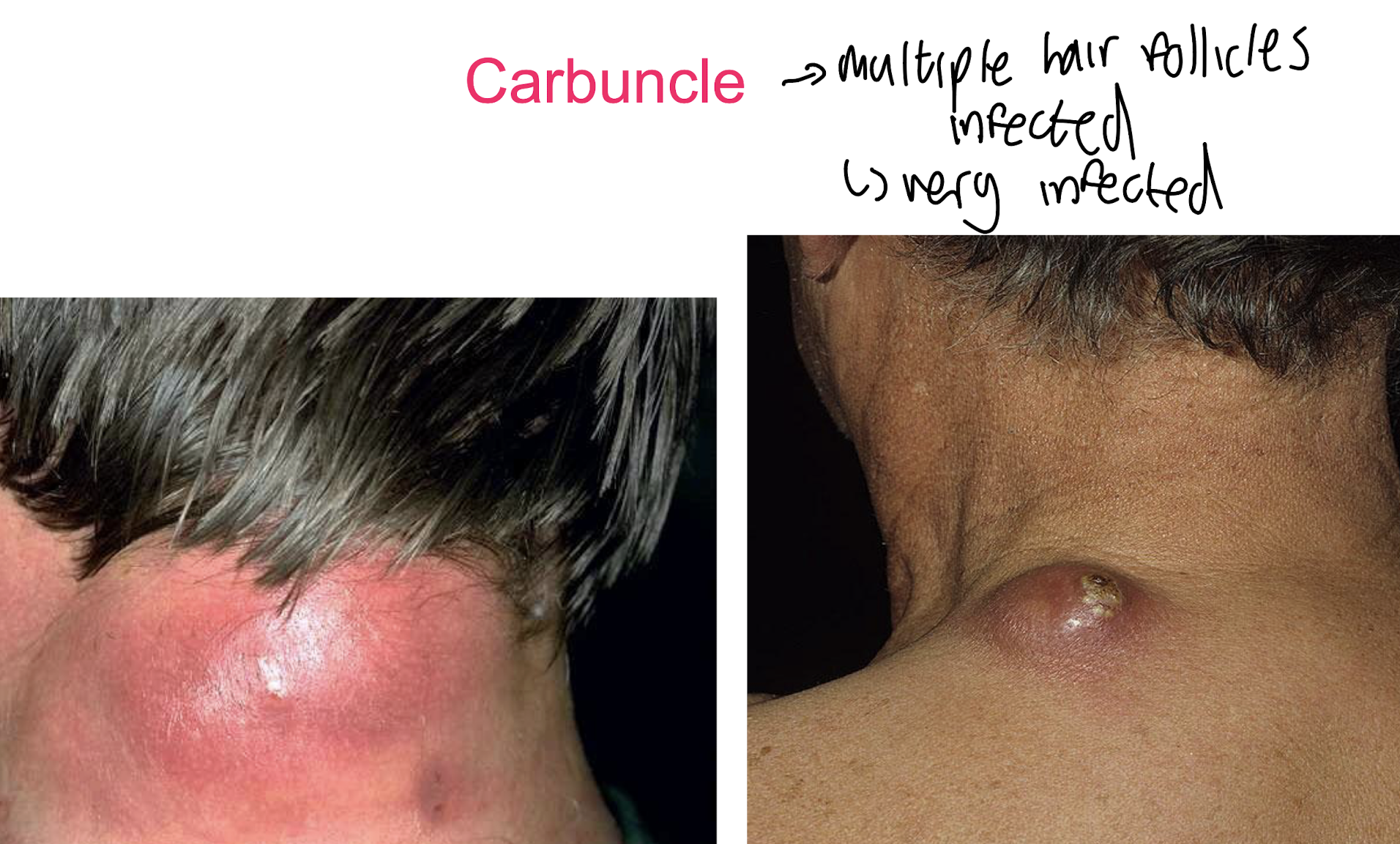 <p><strong>a cluster of interconnected furuncles </strong>(multiple hair follicules infected) <strong>resulting in a</strong><span style="color: red;"><strong> deeper, more extensive infection</strong></span><strong> that affects a larger area of skin. </strong></p>