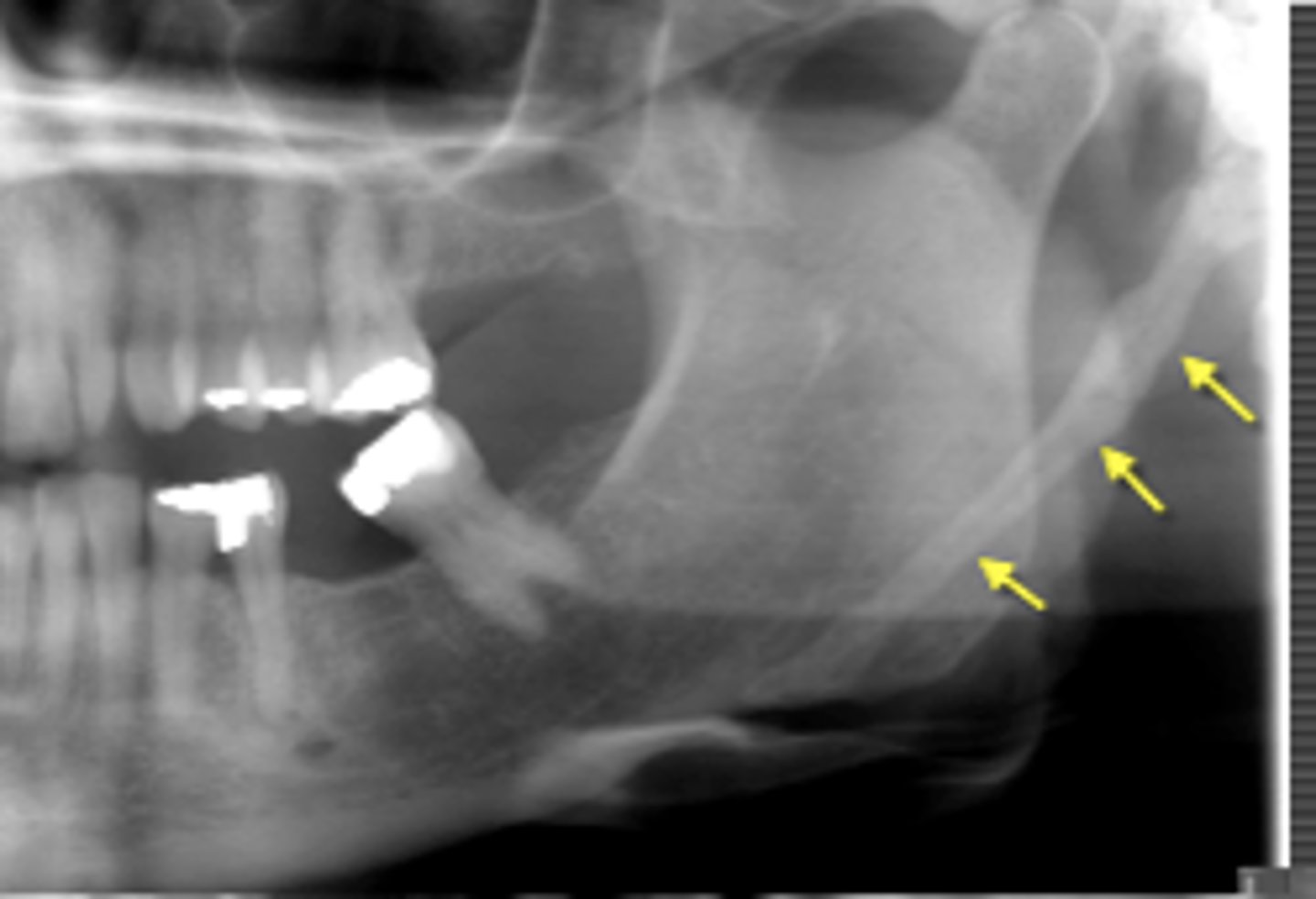 <p>eagle syndome</p><p>temporal styloid process</p>