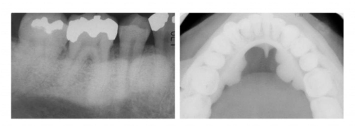 <p>superimposed; roots</p>