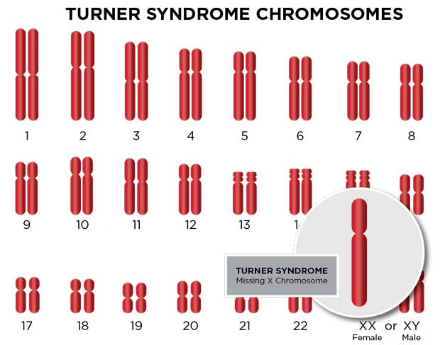 <p>If a gamete with a missing chromosome is fertilised by a normal gamete, the zygote will show monosomy (one chromosome copy, instead of two) → e.g. Turner’s syndrome (X0)</p>