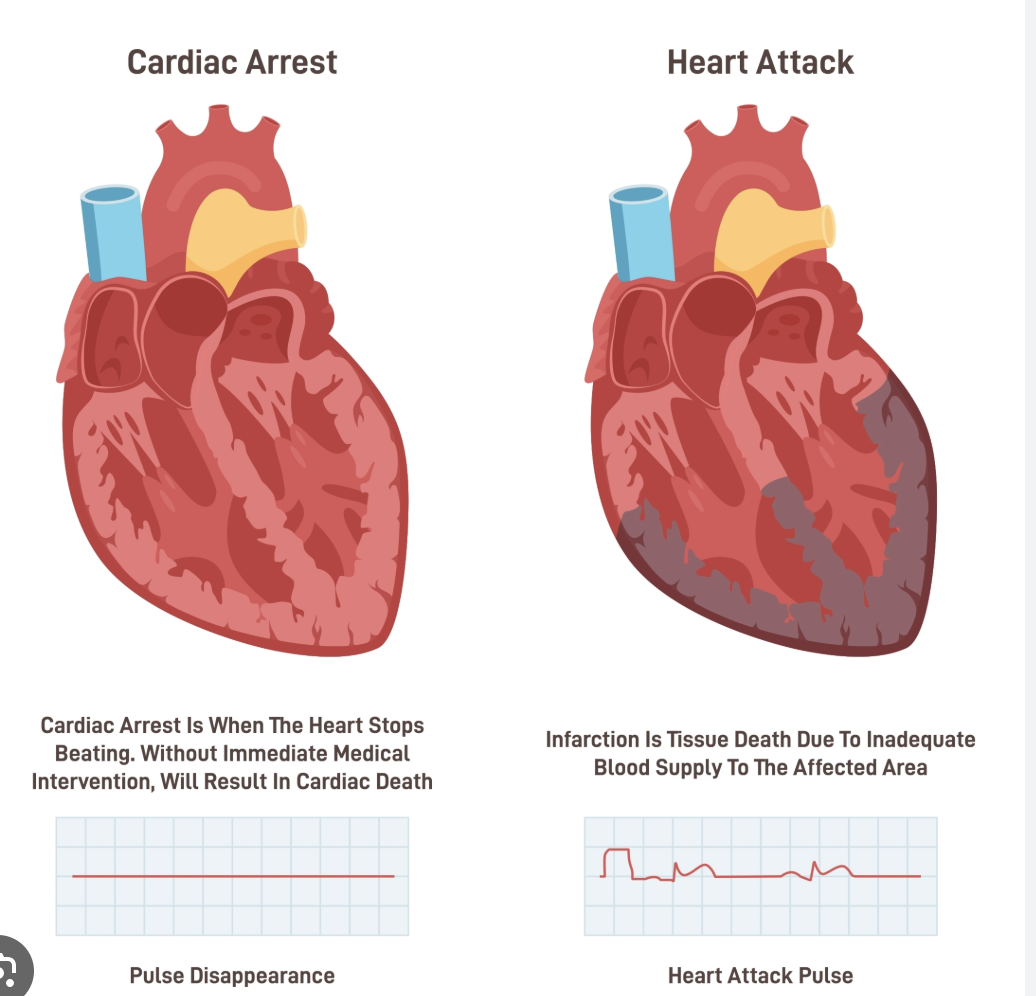 <p>Cardiac Arrest </p><p>Patho</p><p>Signs and symtoms </p><p>mangemnt </p>