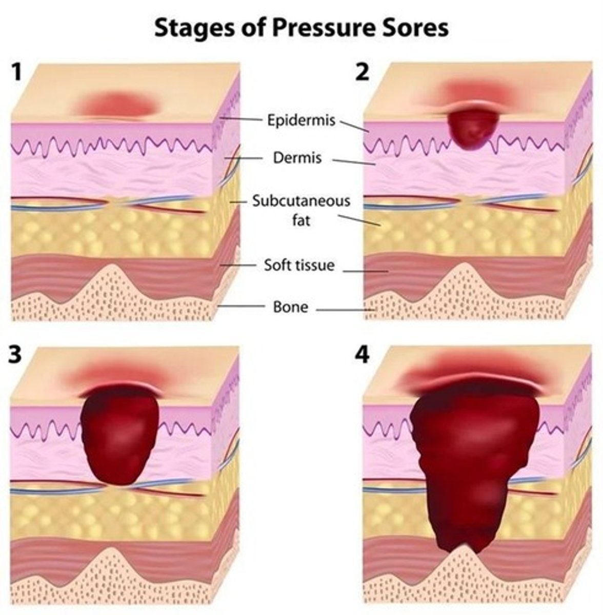 <p>Pressure Sores</p>