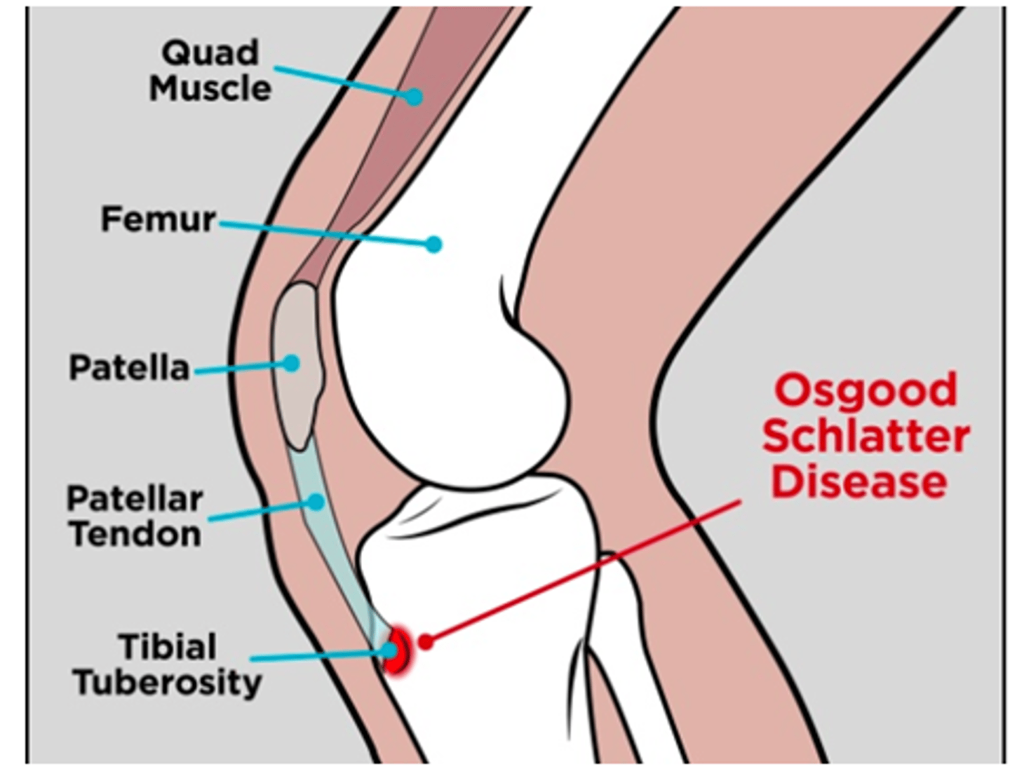 <p>Who is most likely to have Osgood Schlatter's?</p><p>a. A 75 y/o female who is a retired basketball player</p><p>b. A 66 y/o male who plays at the park with his grandchildren</p><p>c. A 25 y/o female who is a PA</p><p>d. An 18 y/o male who plays soccer</p>