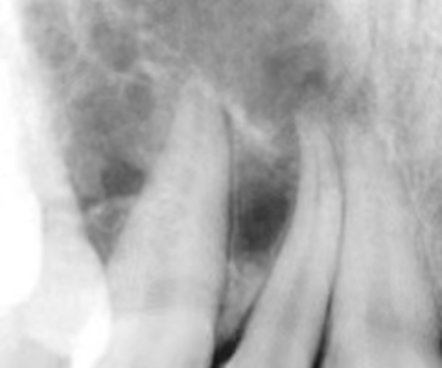 <p>"Soap bubble" or "honeycomb" appearance on a radiograph is associated with what pathologies?</p>