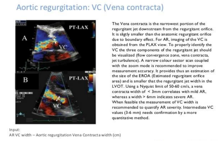 <ul><li><p>Image is zoomed and a narrow sector is used to improve the measurement accuracy.</p></li><li><p>A Nyquist limit of 50-60 cm.sec is typically used.</p></li><li><p>Cineloop through captured image to find the best vena contracta.</p></li><li><p>Measure.</p></li></ul>