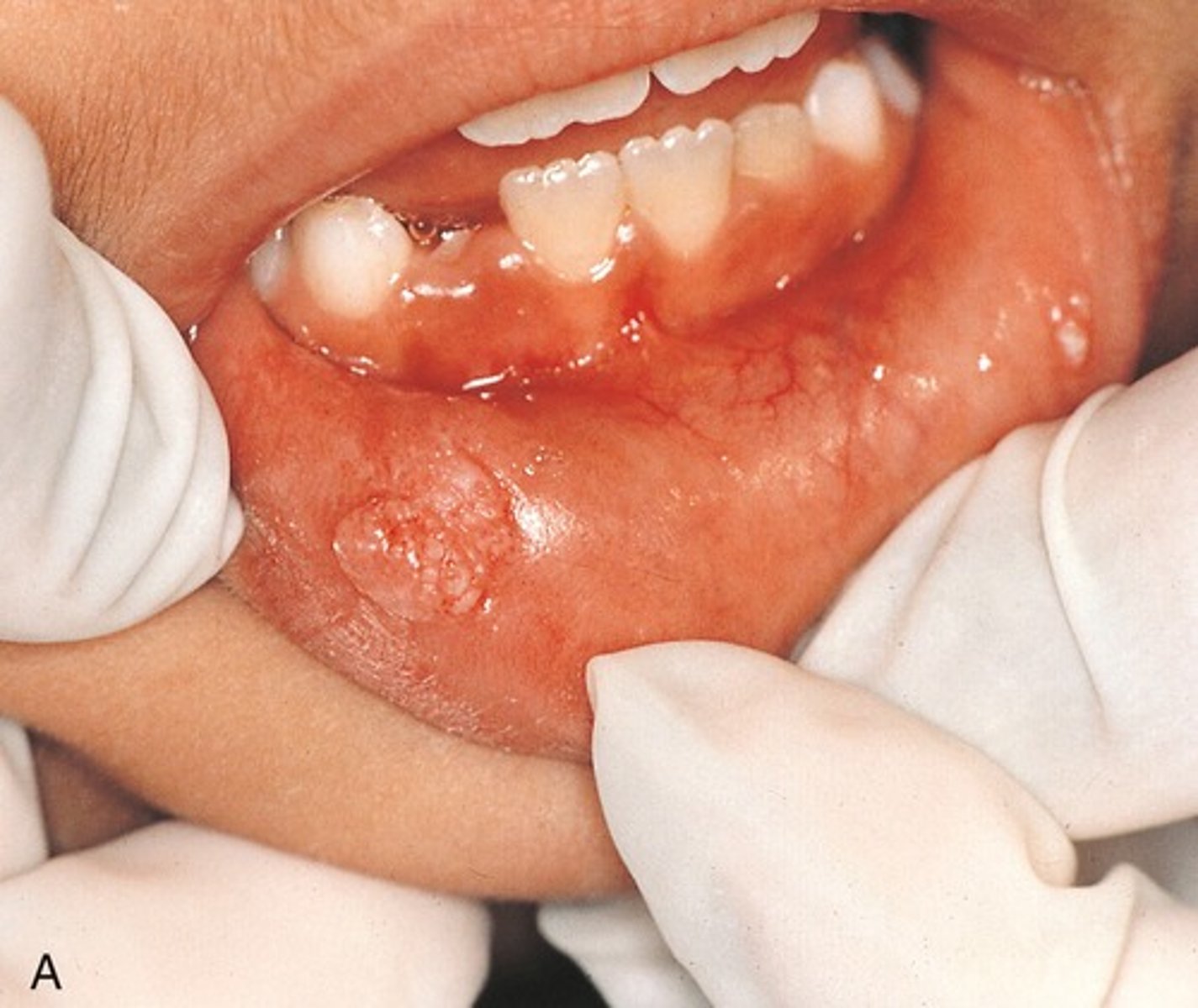 <p>The texture of this lesion would BEST be described as:</p>
