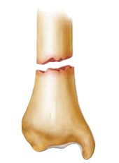 <p>fracture</p>